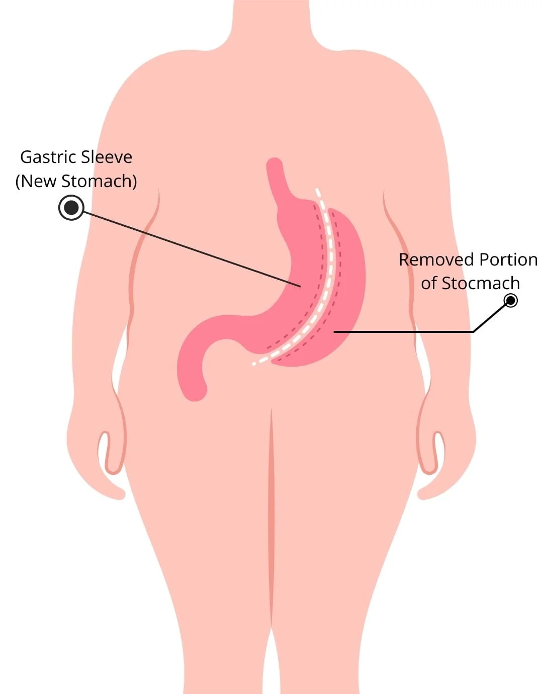 obesity treatment option surgical