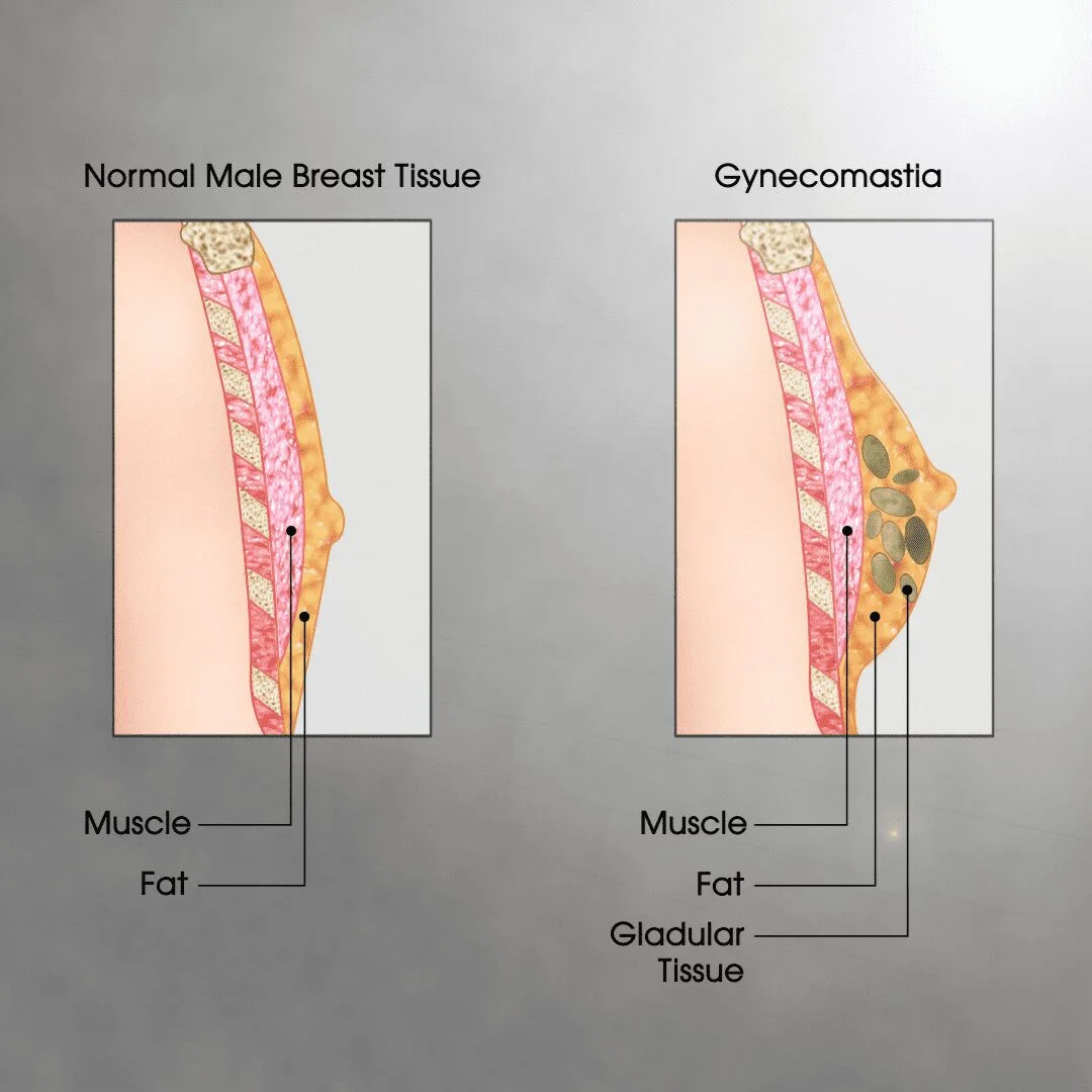 what is gynecomastia