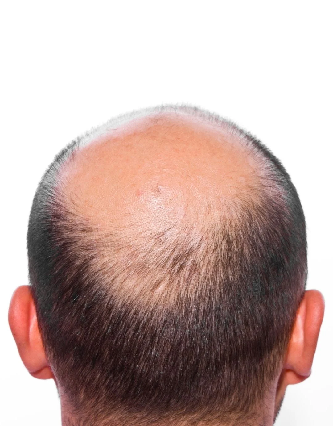 bad candidates of hair restoration surgery