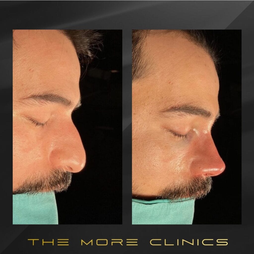 men's rhinoplasty before and after male