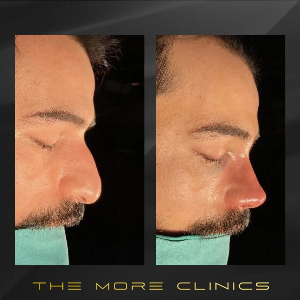 men's rhinoplasty before and after male