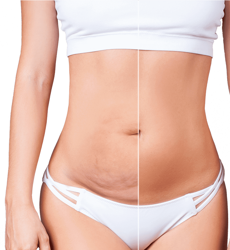 tummy tuck Antalya Turkey