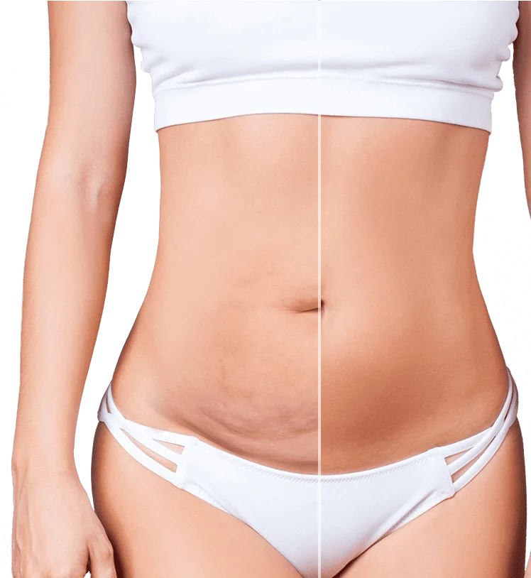How much does a Tummy Tuck Cost & All Details