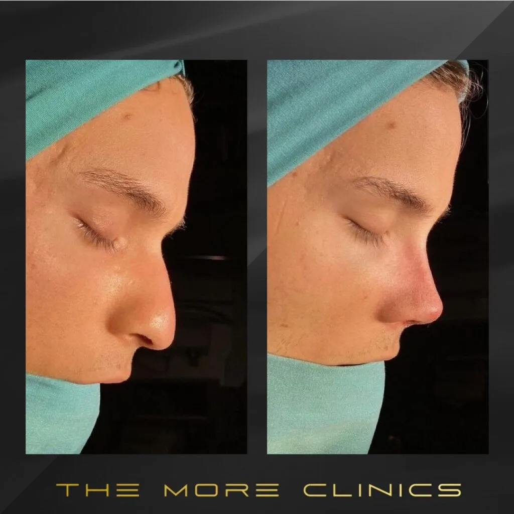natural nose job before and after rhinoplasty