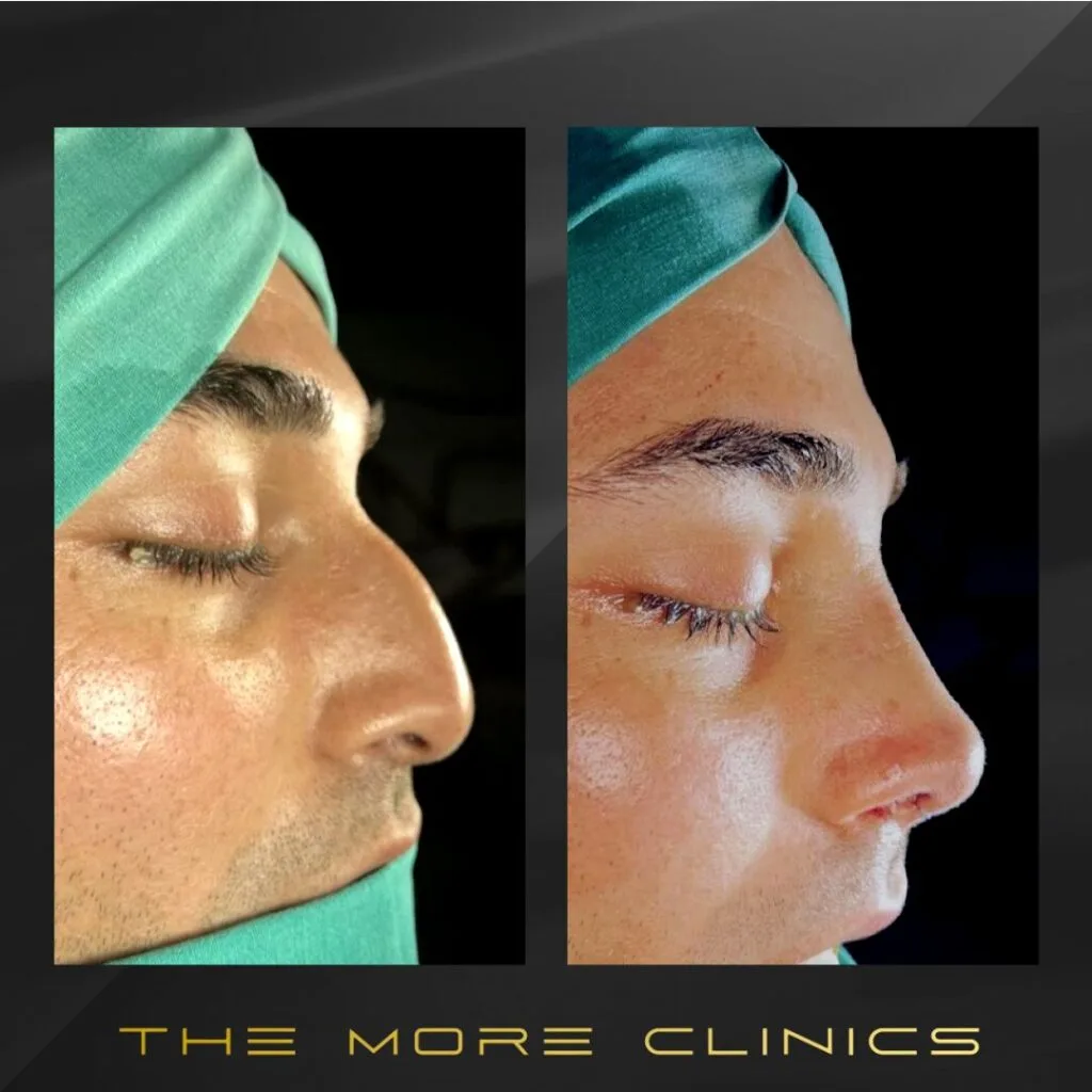 men rhinoplasty before after