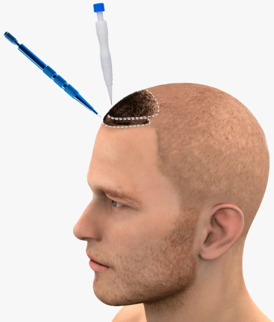 how does a hair transplant work in detail