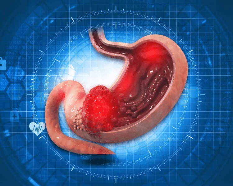 Different Types of Bariatric Treatments