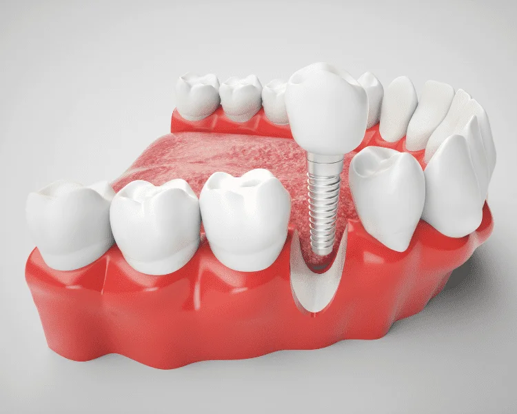 Dental Bone Graft: All You Need to Know