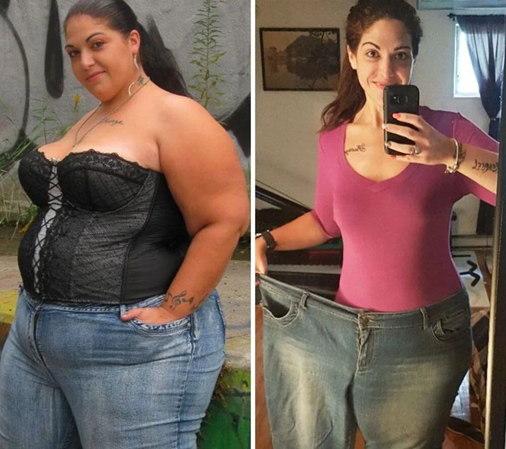 Bariatric Surgery Before and After