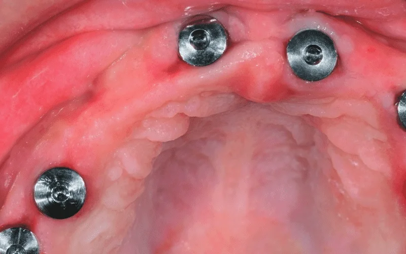 dental implant aftercare guide