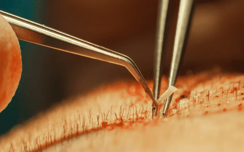 hair transplant and restoration