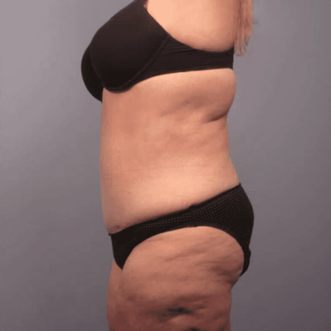 mommy makeover before and after
