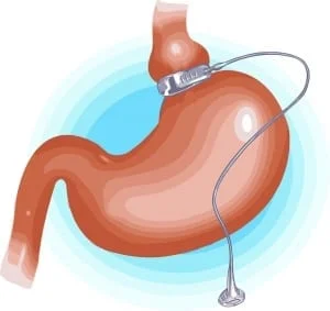Laparoscopic Adjustable Gastric Banding Guide (Lap Band)