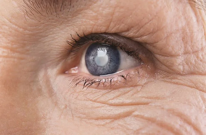 cataract surgery recovery timeline