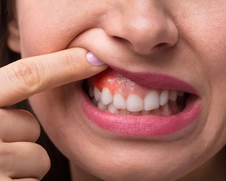 gingivitis swelling gum