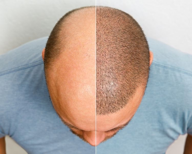 Antalya DHI Hair Transplant