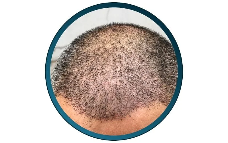 shock loss or hair shedding as a side effect