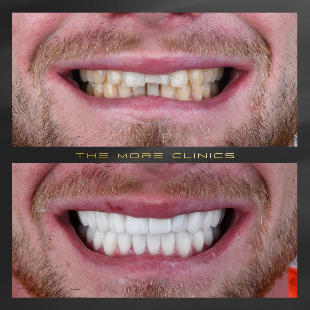 Dental Veneers before and after turkey