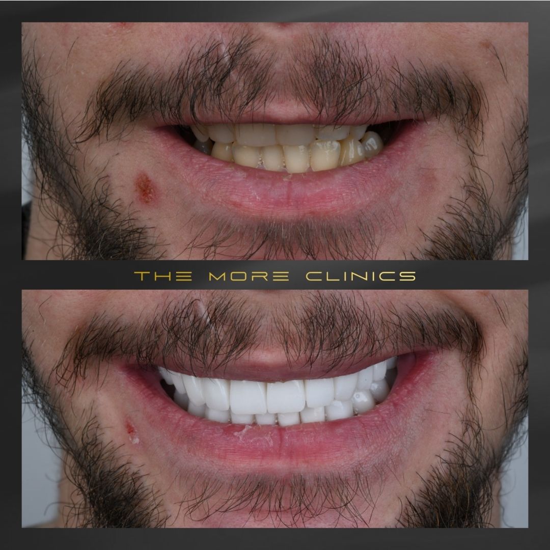 smile makeover in Turkey