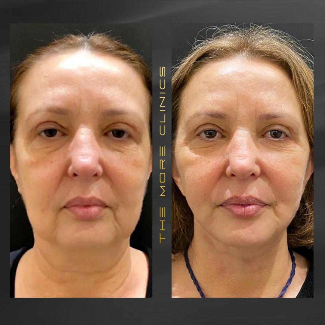 face and necklift turkey before after