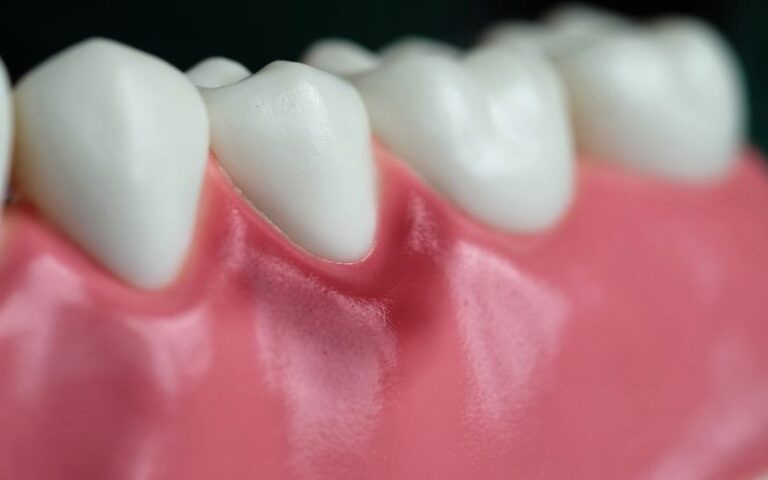 Antalya periodontitis