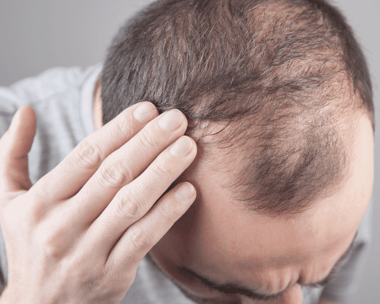 testosterone cause hair loss