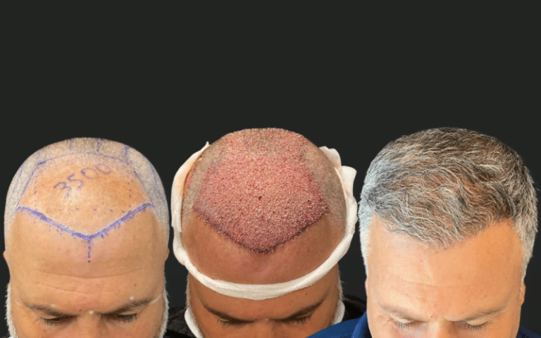 Antalya Hair Transplant