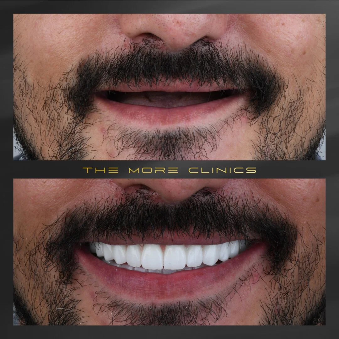 dental implants before after