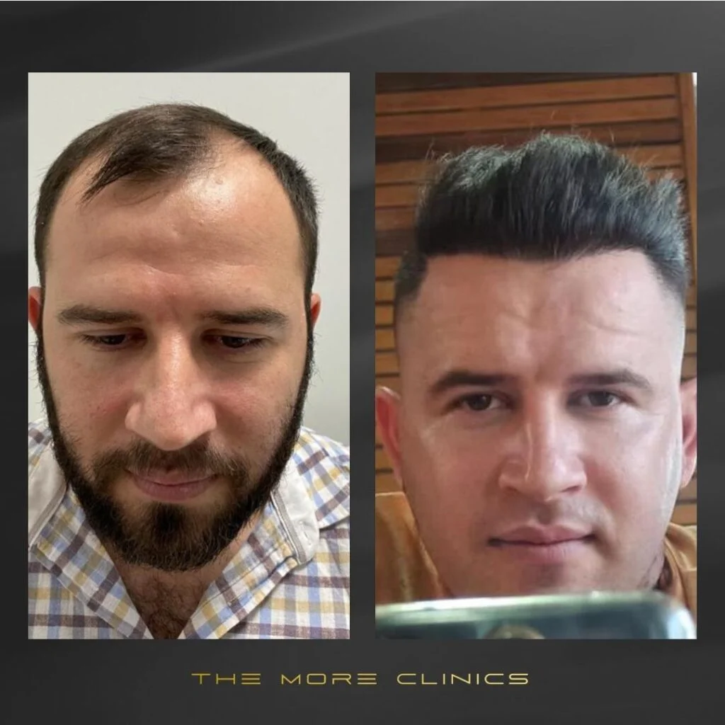 DHI Haartransplantation vorher nachher Türkei Antalya