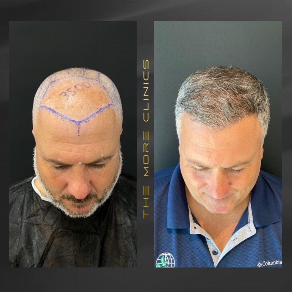 Haartransplantation vorher nachher Türkei Antalya