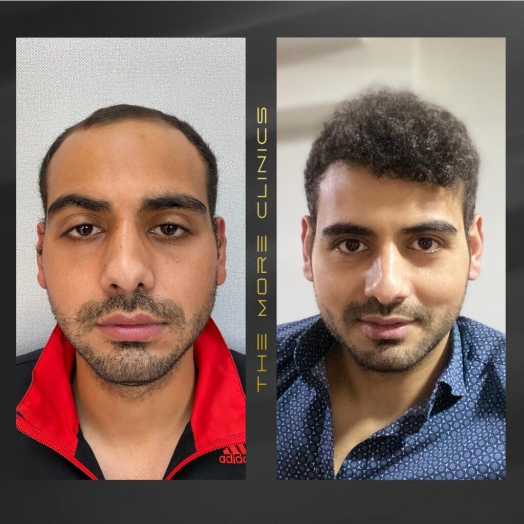 DHI Haartransplantation vorher nachher Türkei Antalya