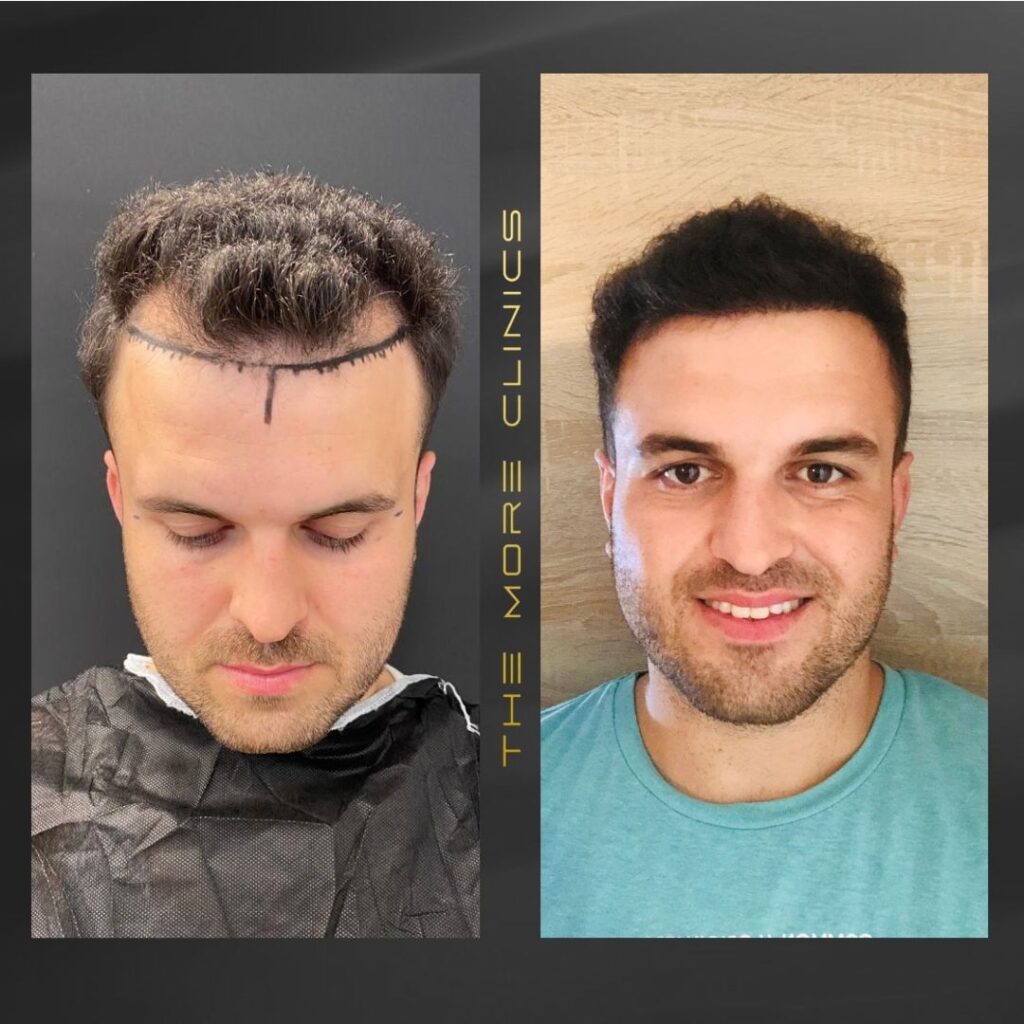 Haartransplantation vorher nachher Türkei Antalya