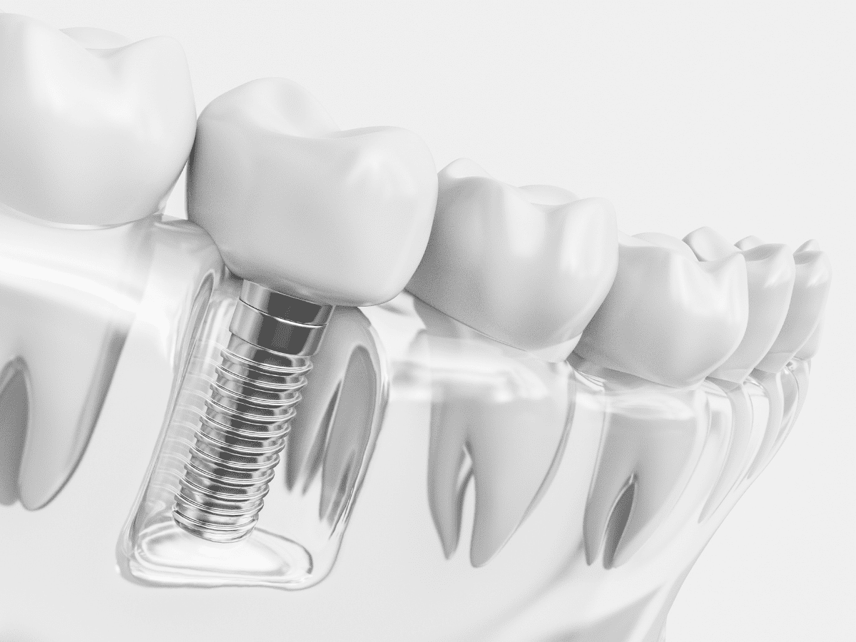 Antalya Dental Implant