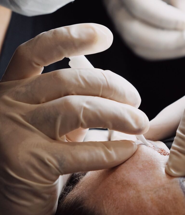 Hair Transplants in Nottingham
