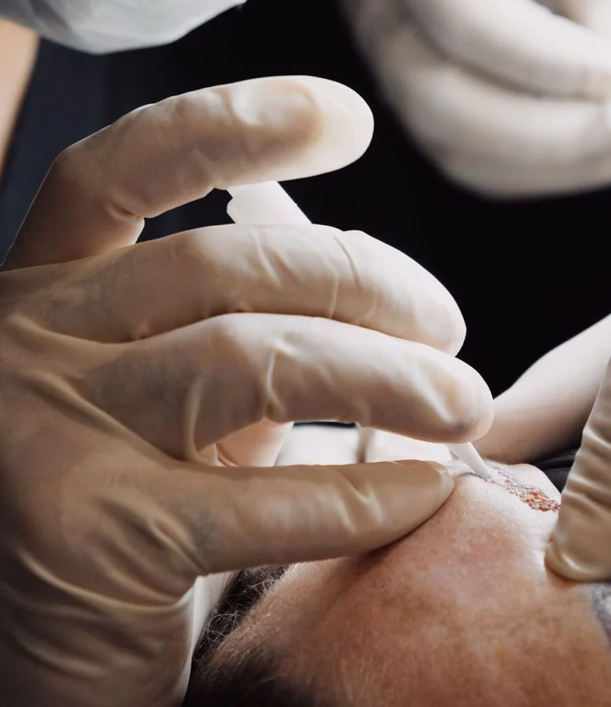 Antalya Hair Transplant
