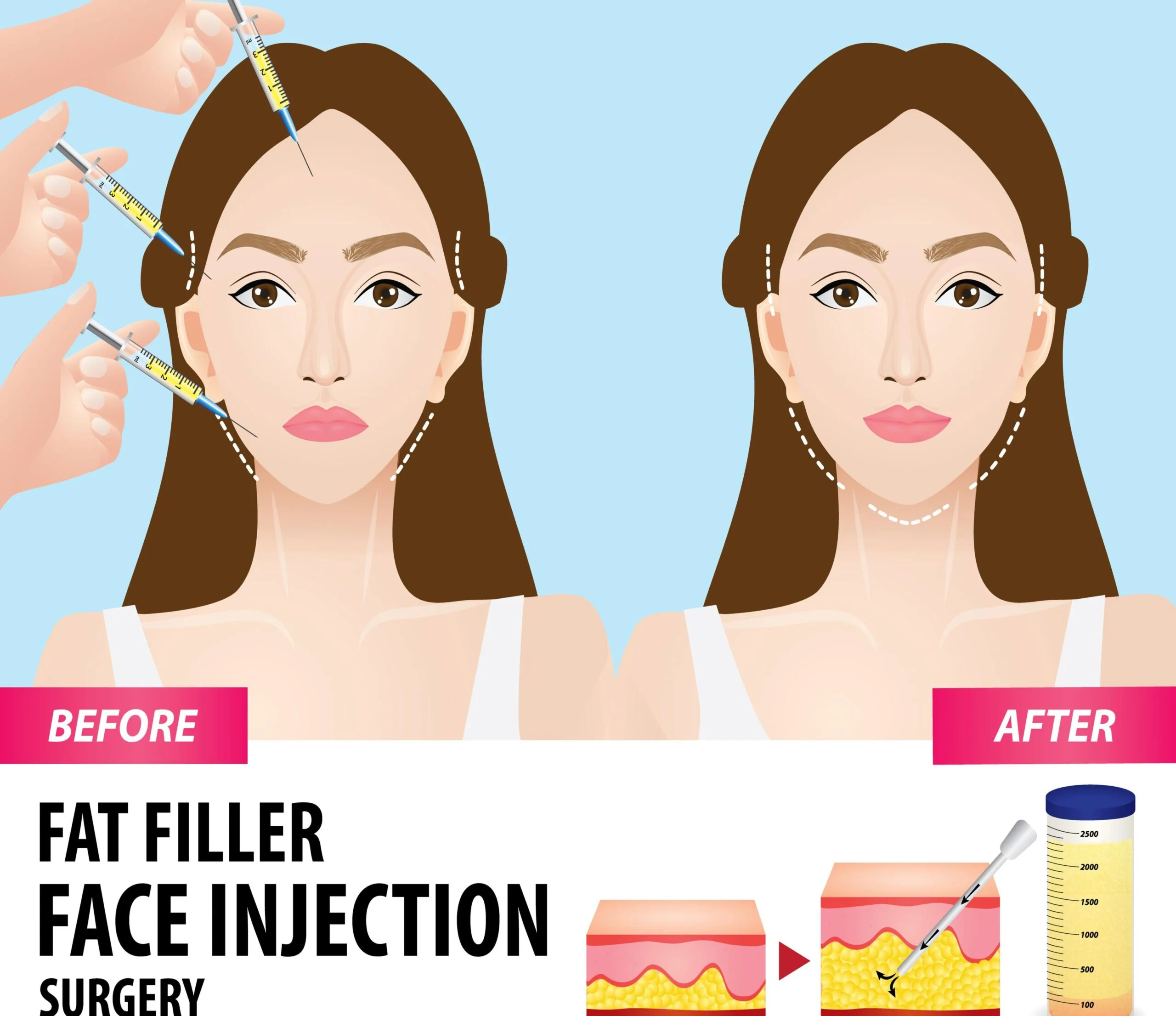 fat transfer to the face