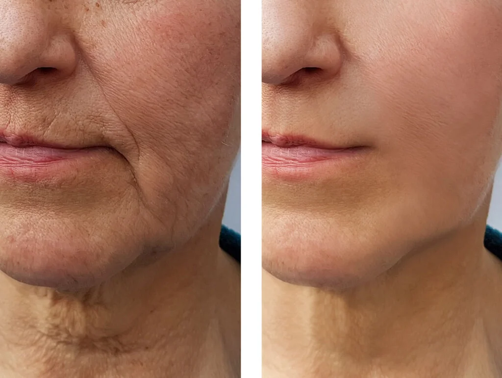 fat transfer turkey cost fat transfer to face before and after