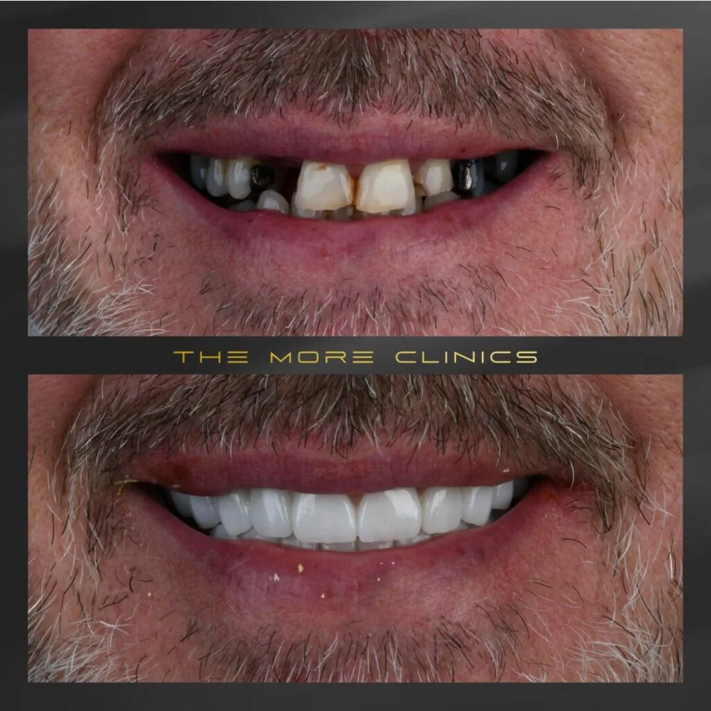 front tooh crown restoration before and after