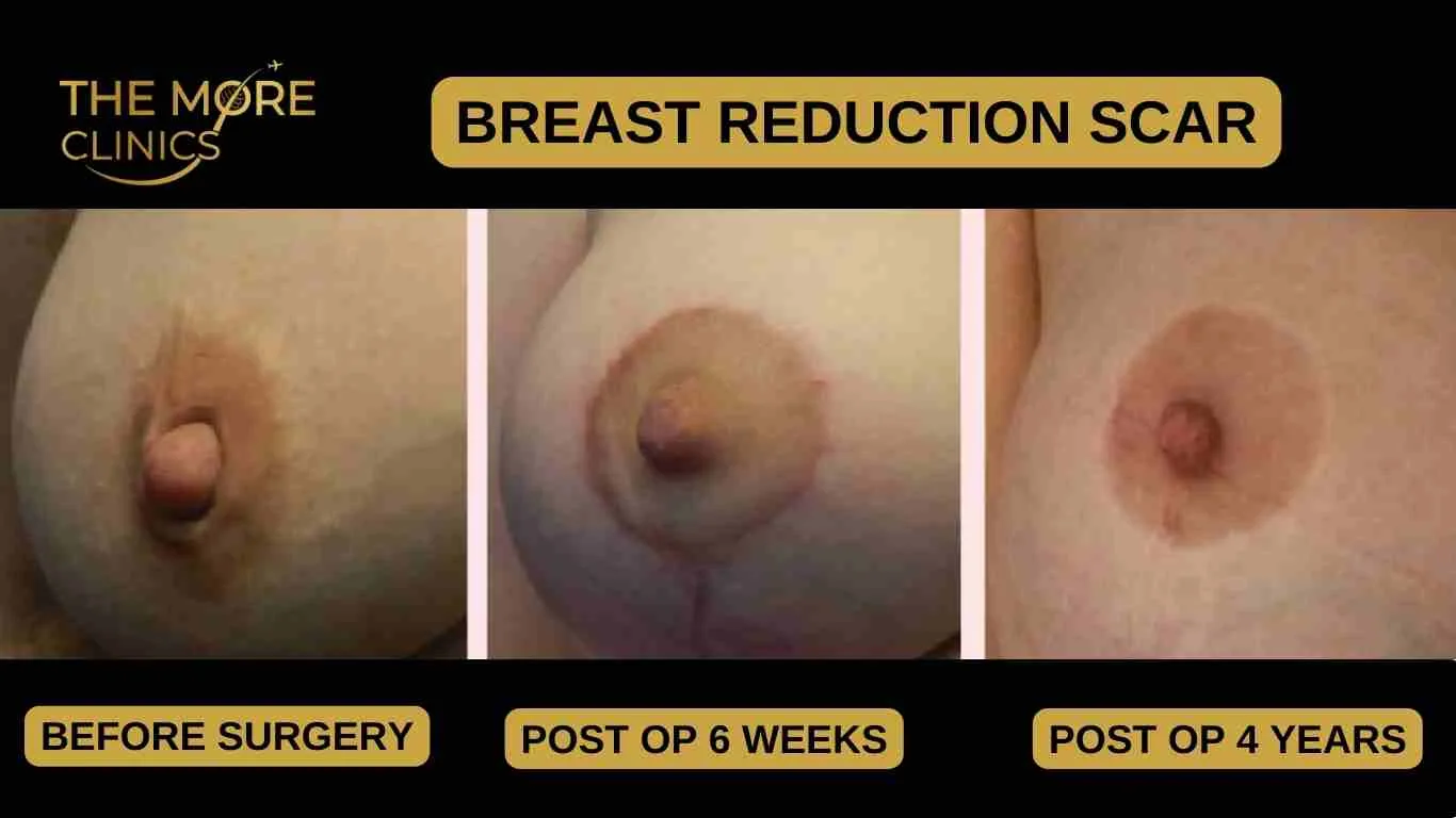 Healed Breast Reduction Scars on Light Skin