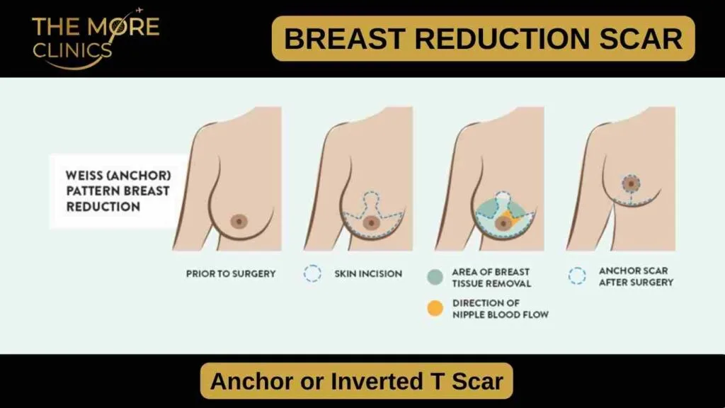 surgery scar anchor shaped