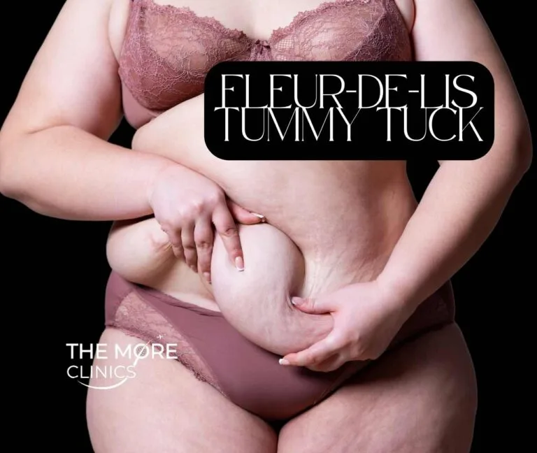Fleur De Lis Tummy Tuck: A Comprehensive Guide