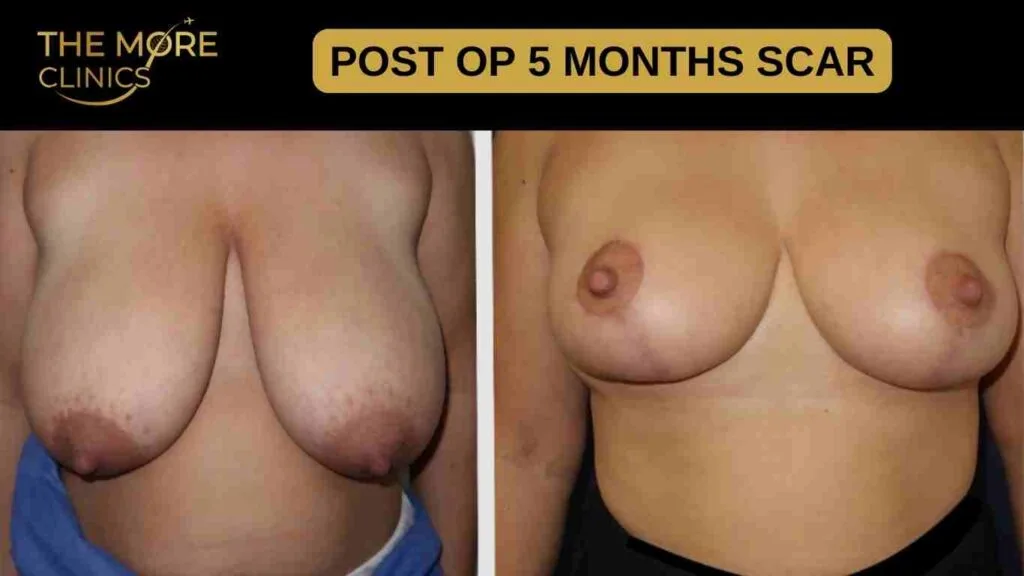 Healed Breast Reduction Scars on Light Skin