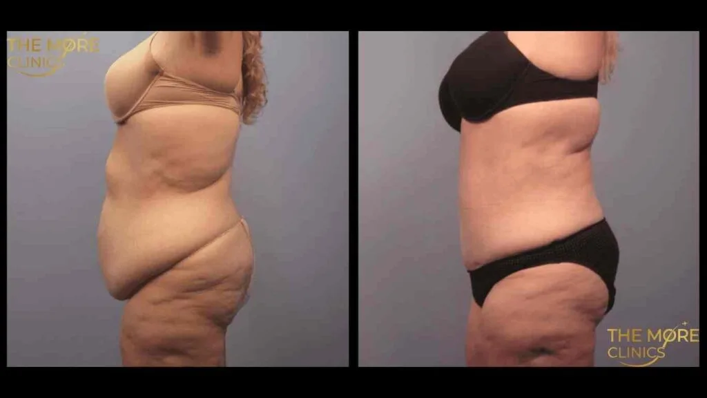 360 lipo turkey liposuction before and after