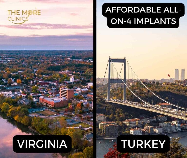 affordable all-on-4 implants in virginia​