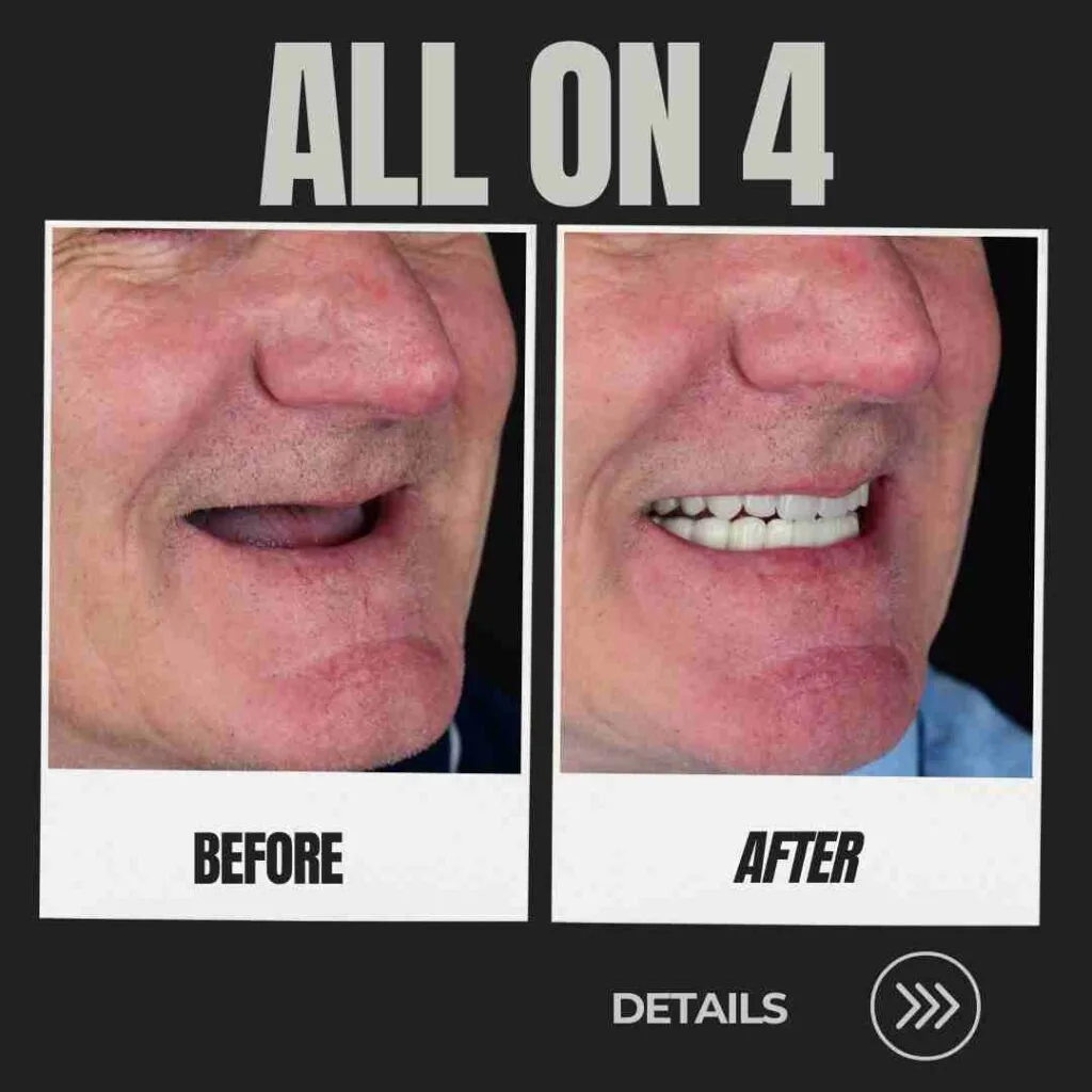 all on 4 turkey dental implants before and after