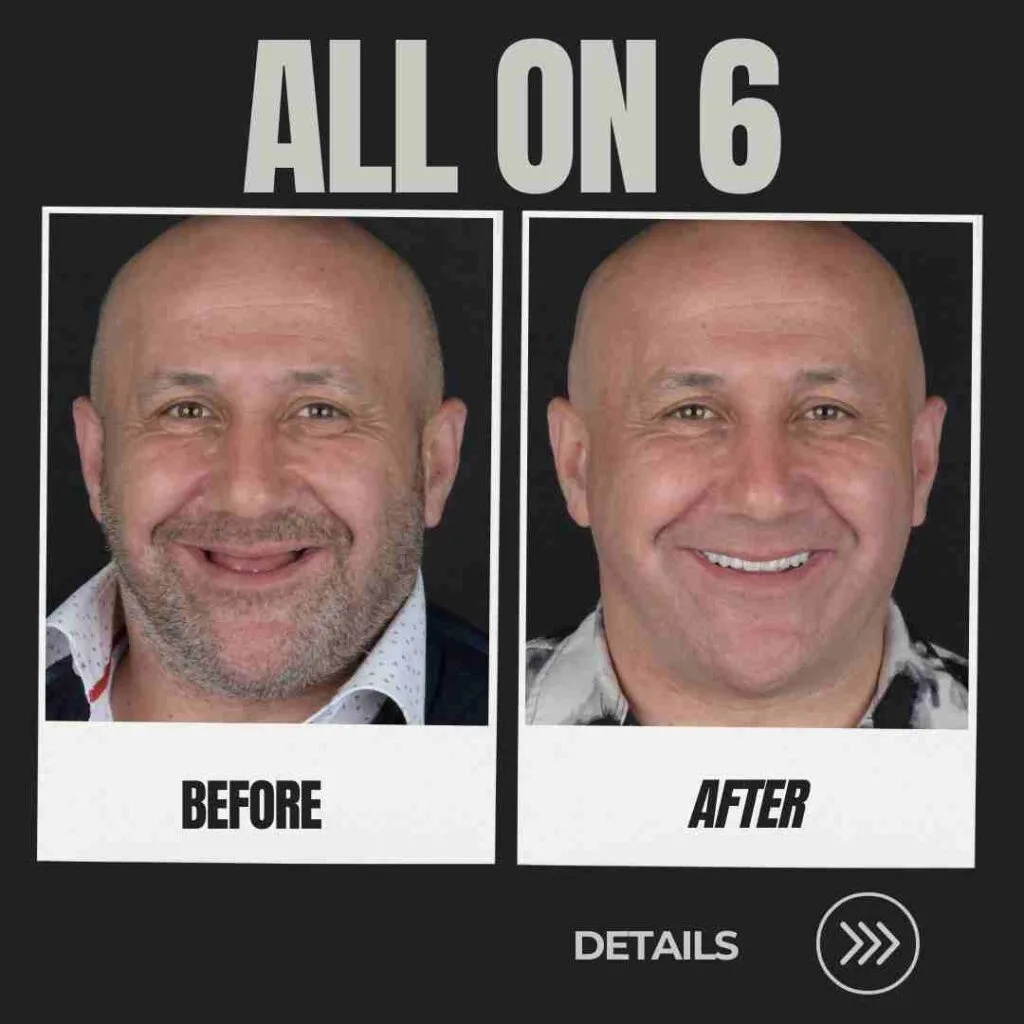 all on 6 turkey dental implants before and after