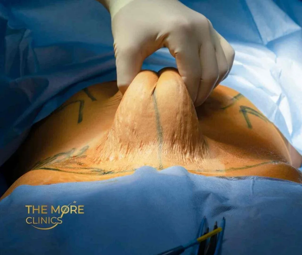 beste abdominoplastik türkei