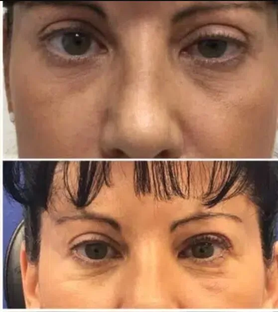 upper eyelid surgery gone wrong