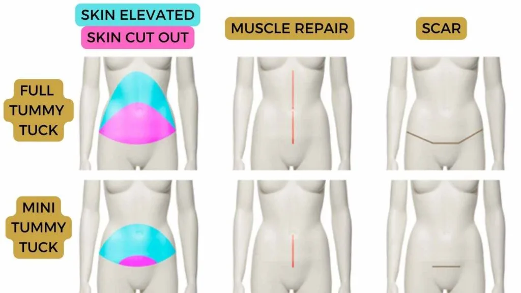 types: full and mini tummy tuck comparison of scars and incisions