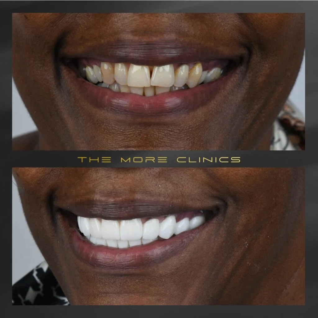 smile design turkey teeth before and after